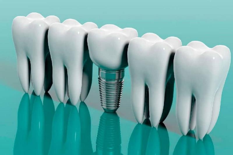 Владимир Лосев рассказал о главных мифах про установку зубных имплантатов