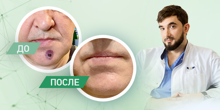 Рак кожи можно вылечить без операции